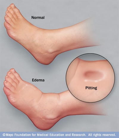 Que Es Edema Gestacional volviéndose viral Que Es Edema Gestacional volviéndose viral
